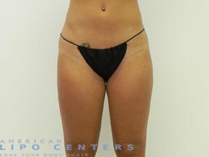 americanlipocenters_155.jpg